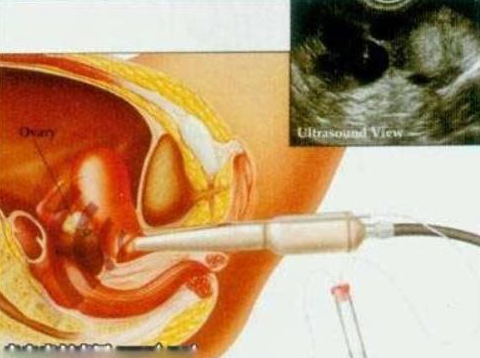 试管婴儿之胚胎植入