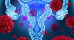 出国看病资讯：贝伐珠单抗可以延长某些卵巢癌患者的生存期
